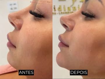 Resultado de antes e depois 1