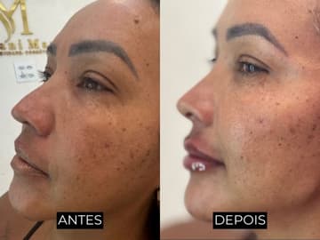 Resultado de antes e depois 2