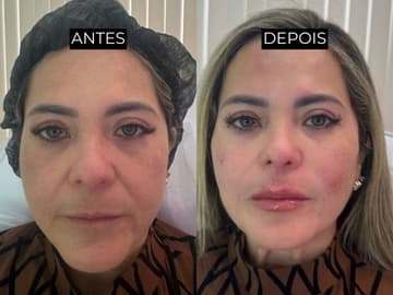 Resultado de antes e depois 3