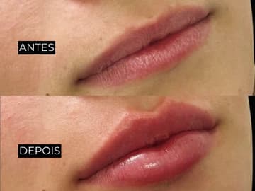 Resultado de antes e depois 4